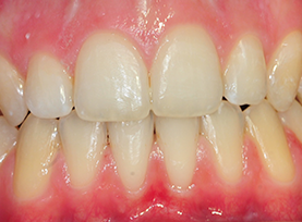 After Treatment